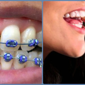 clear braces with purple bands