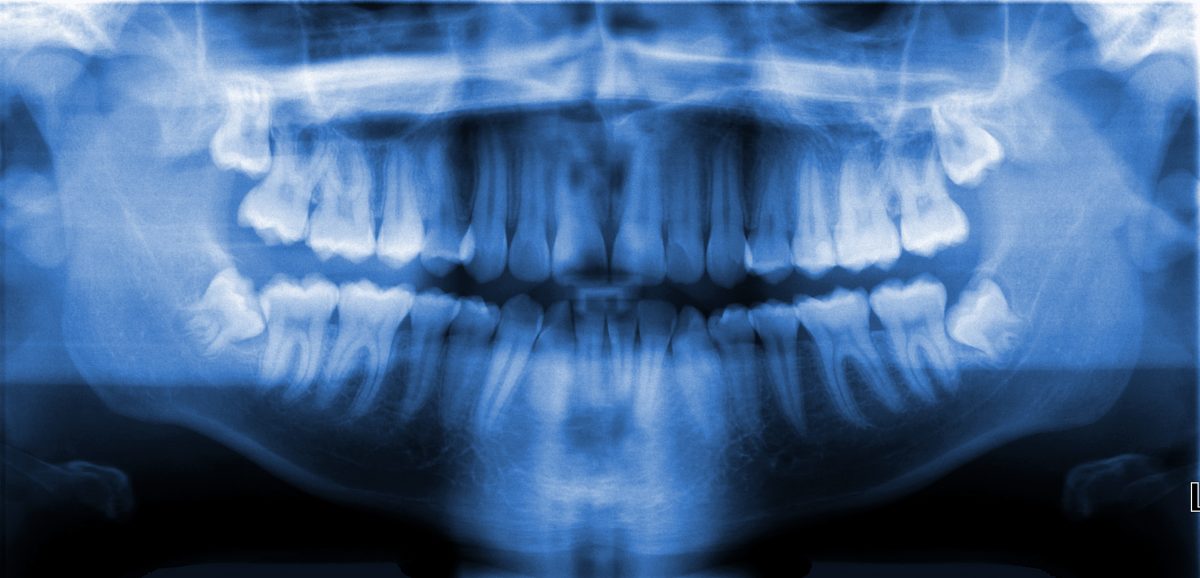 Edmond Dentist Explains Digital XRays Vs. Film XRays Gray Dental