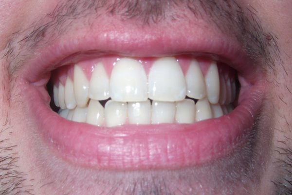dental implants philip m gray dentistry dentist in edmond ok