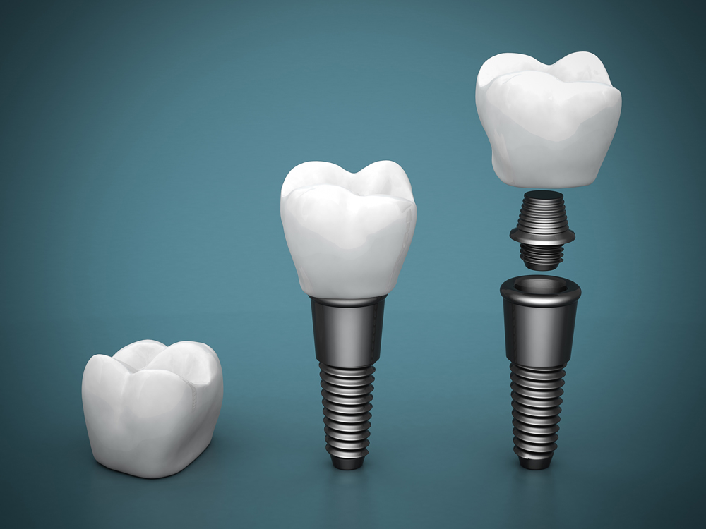 Titanium dental implants | Gray Dental Group | Edmond, OK 73034