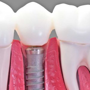Dental Implants in Edmond
